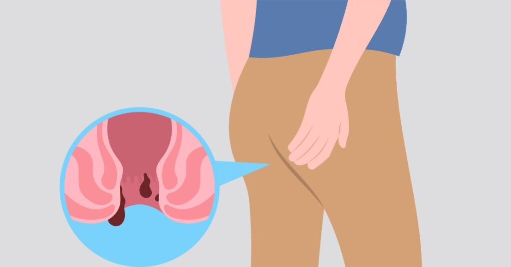 Piles Treatment